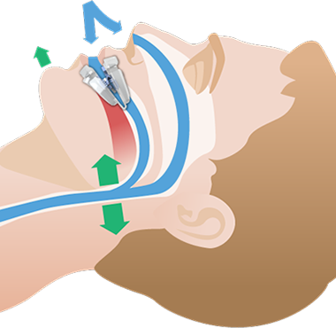 Illustrations for VitalSleep anti-snoring device.
